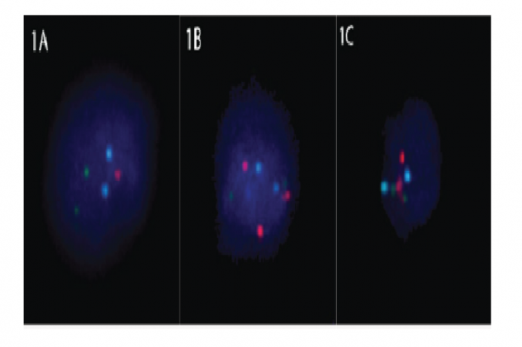 FISH results of interphase cells (a) Cell with monosomy of chromosome 21 (b) Cell with trisomy of chromosome 21 (c) Cell with disomy of chromosome 21. Colour Legend: RED - chromosome 21; Green - chromosome 13; Blue - chromosome 18. [full page width].