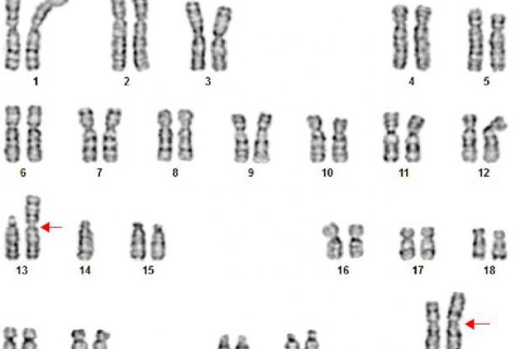 Case two with isochromosome Xq and Robertsonian translocation t(13;14)