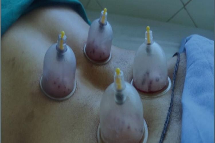 Cupping therapy.