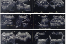 Real-time ultrasound sonography of abdomen and pelvis pre treatment
